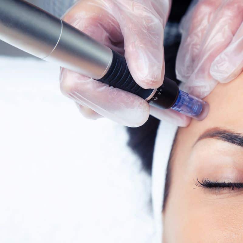 Morpheus8 treatment Hayes from Lipo Sculpt - Book in today!